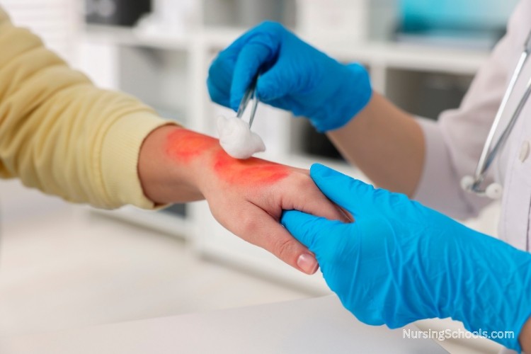 Wound Care Nurse assesses, treats, and monitors the healing of a burn wound on a patient's hand.